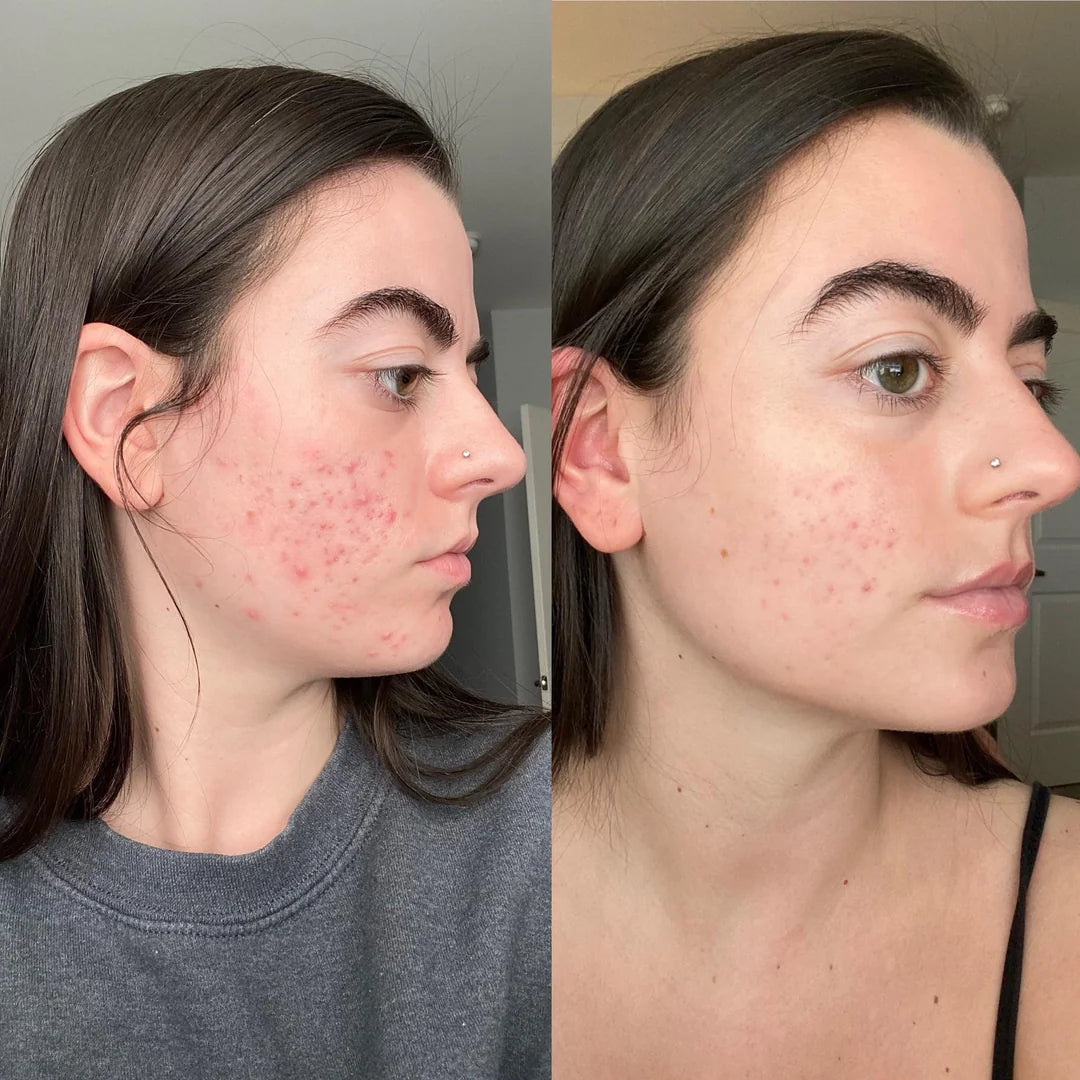 Avevo delle cicatrici da acne che mi facevano sentire a disagio da anni