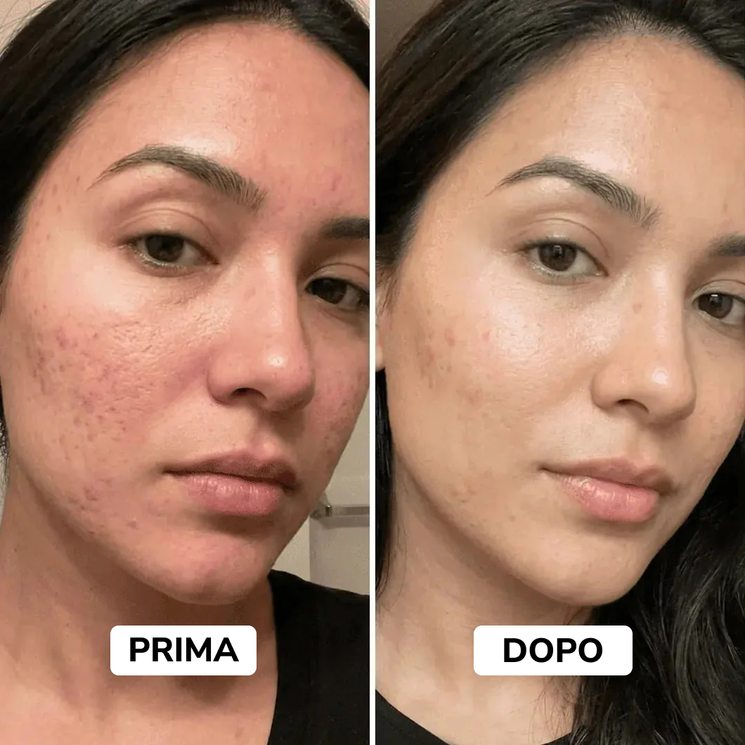 Stick riparatore per cicatrici da acne
