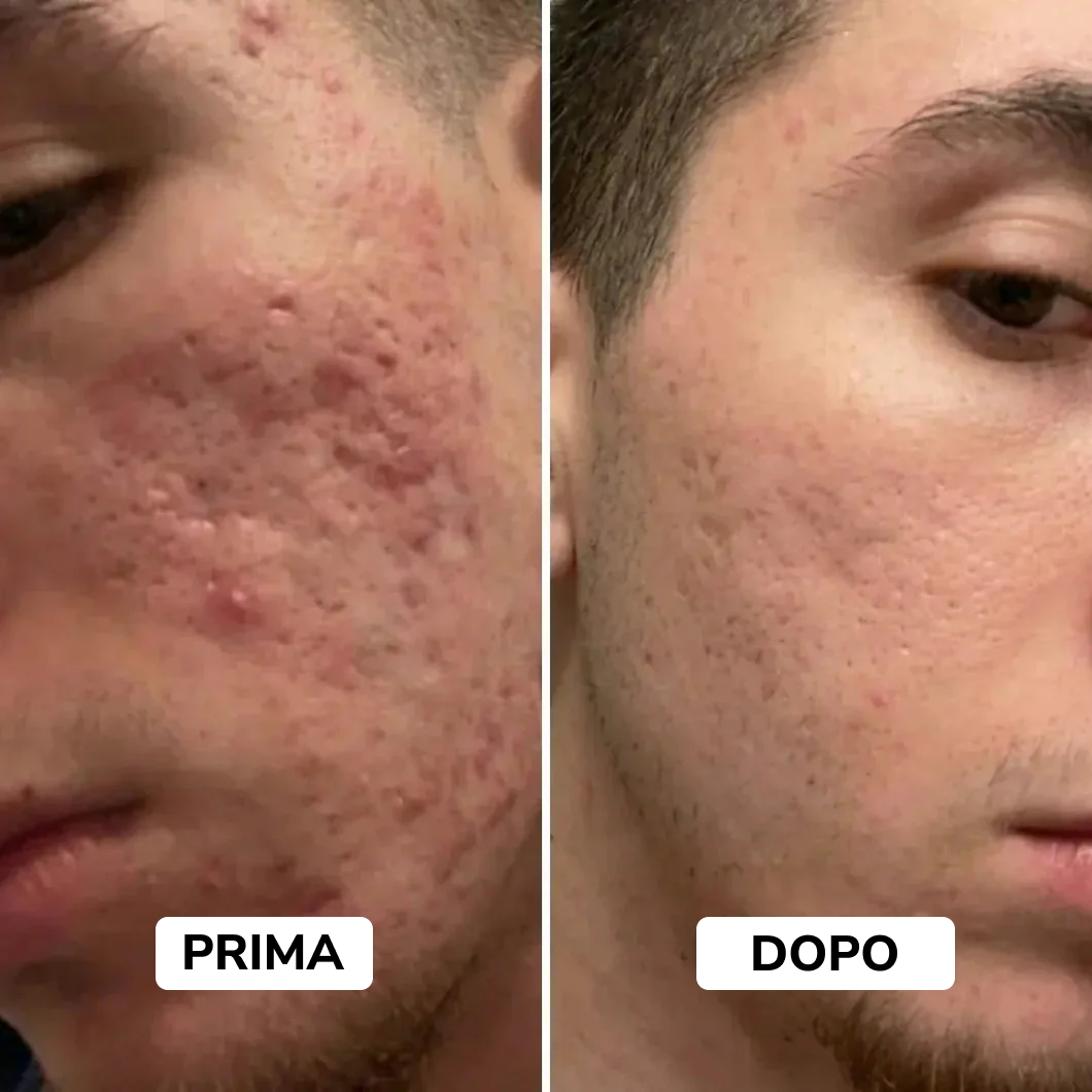 Stick riparatore per cicatrici da acne
