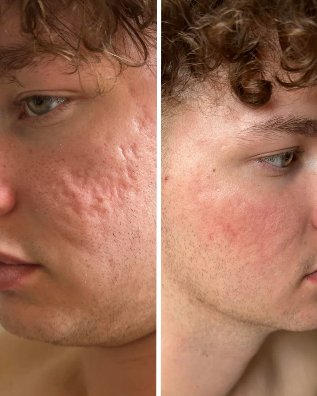 L'ho comprato per mio figlio che soffriva di acne e aveva lasciato diverse cicatrici
